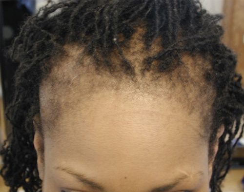 trichologist london hair thinning london service image 1