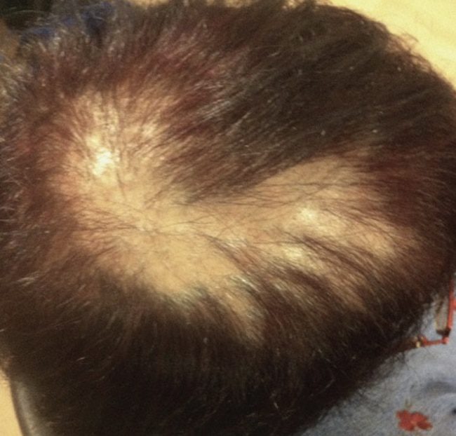 trichologist london scalp treatment service scarring alopecias